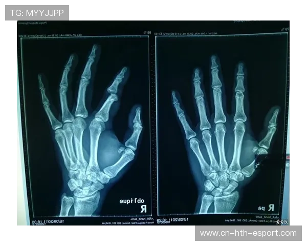 手指脱臼：队医一拉，咔嚓一声，继续上场，手指脱臼能自愈吗